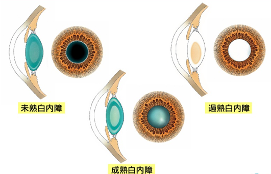 白内障について