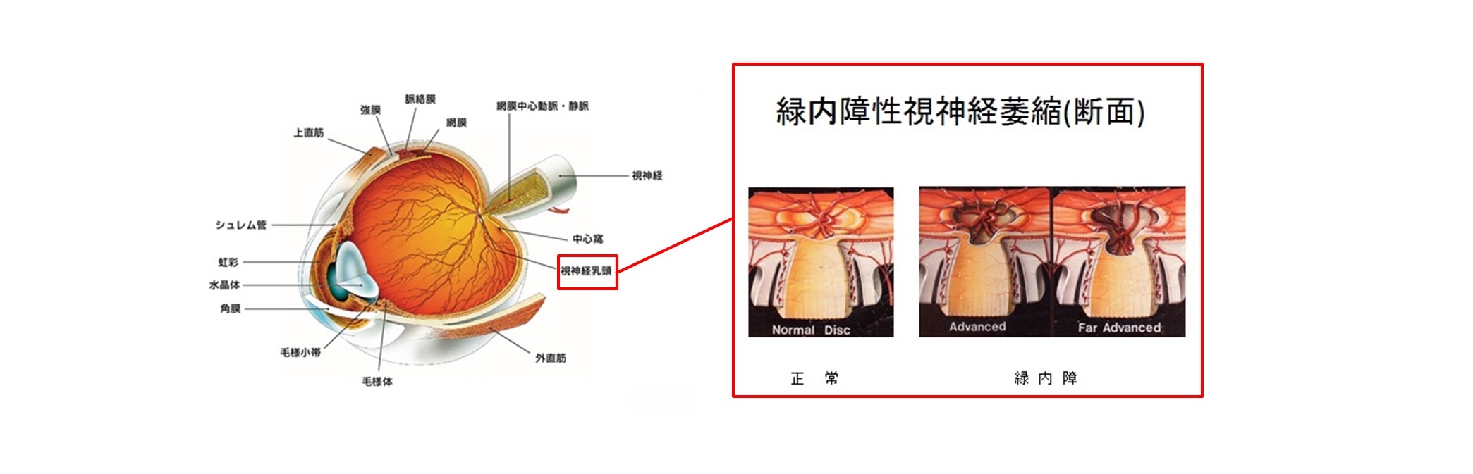 緑内障断面図